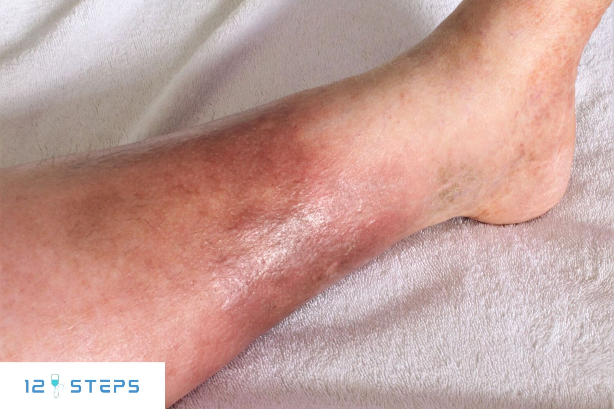 Ін’єкційні наркотики та тромбоз глибоких вен