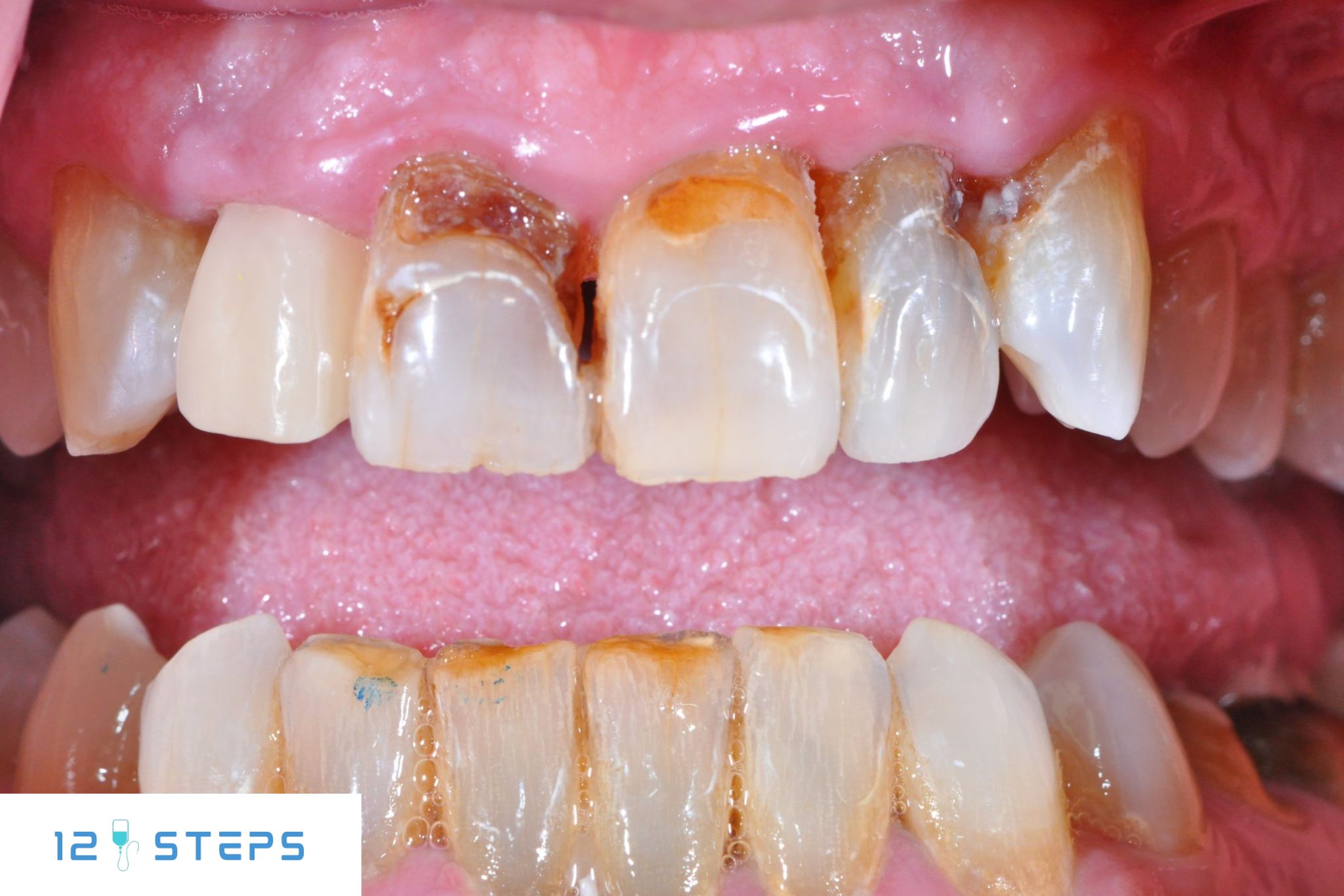 Почему метамфетамин разрушает зубы быстрее, чем сахар